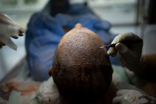 How Turkey Hacked the Hair Transplant Industry